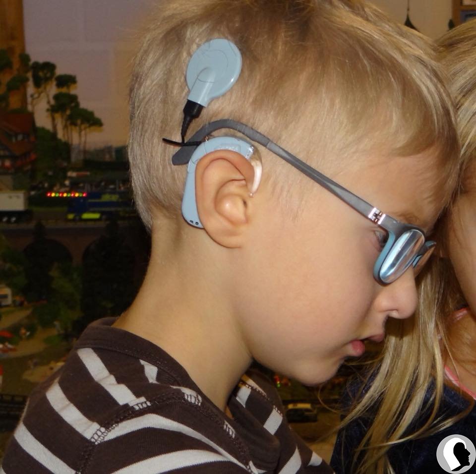 CI Kopf 2018 männlich Kind